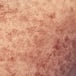 Discoloration